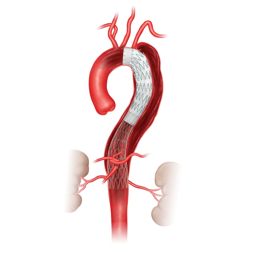Zenith® Dissection