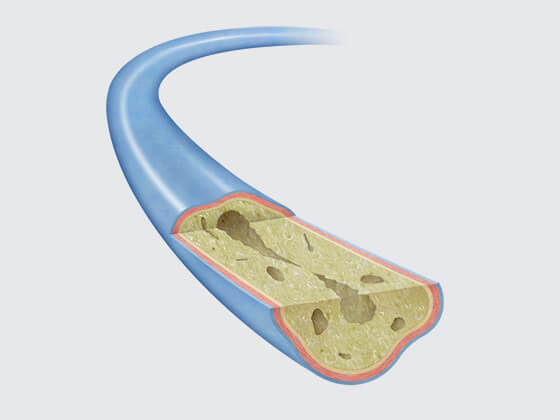 Deep venous obstruction